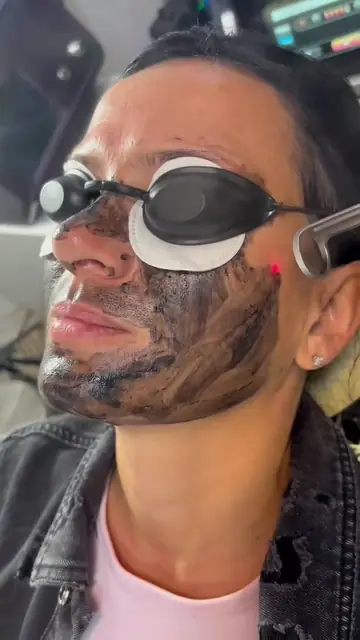 Peeling cu carbon
