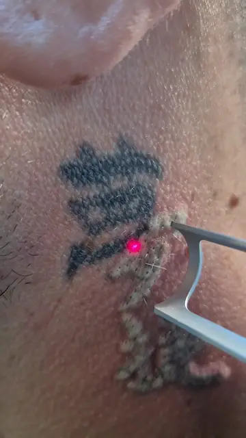 Impuls laser pe un tatuaj vechi