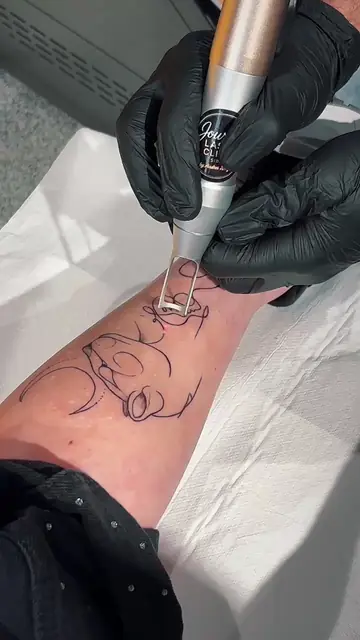 Îndepărtarea unui tatuaj fin
